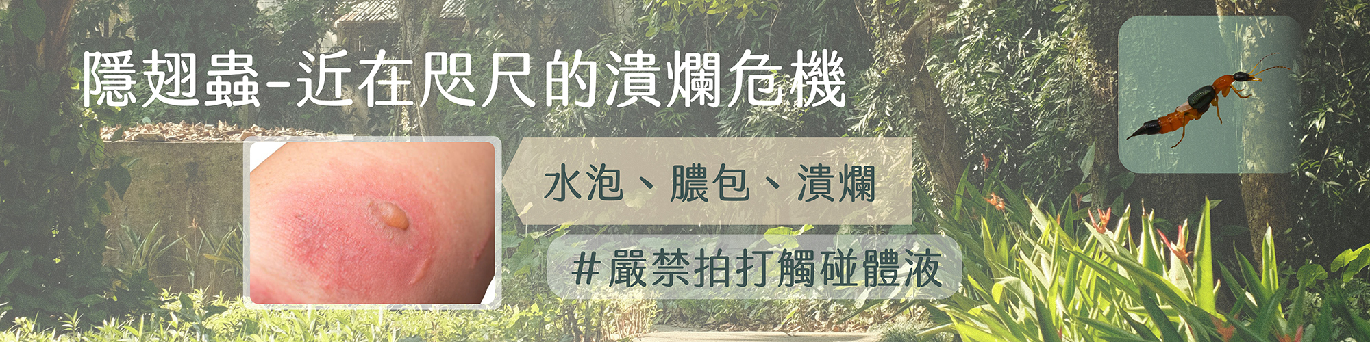 隱翅蟲,隱翅蟲咬人,隱翅蟲體液,隱翅蟲潰爛,rove beetle,rove beetle bite / sting,ove beetle skin burn / wound