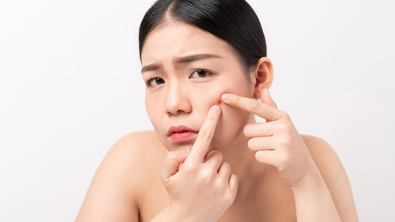 你的痘痘總是固定長在額頭、下巴、鼻翼，甚至背部嗎？