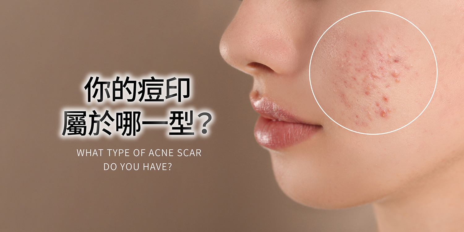 你的痘疤或痘印是屬於哪一類型呢