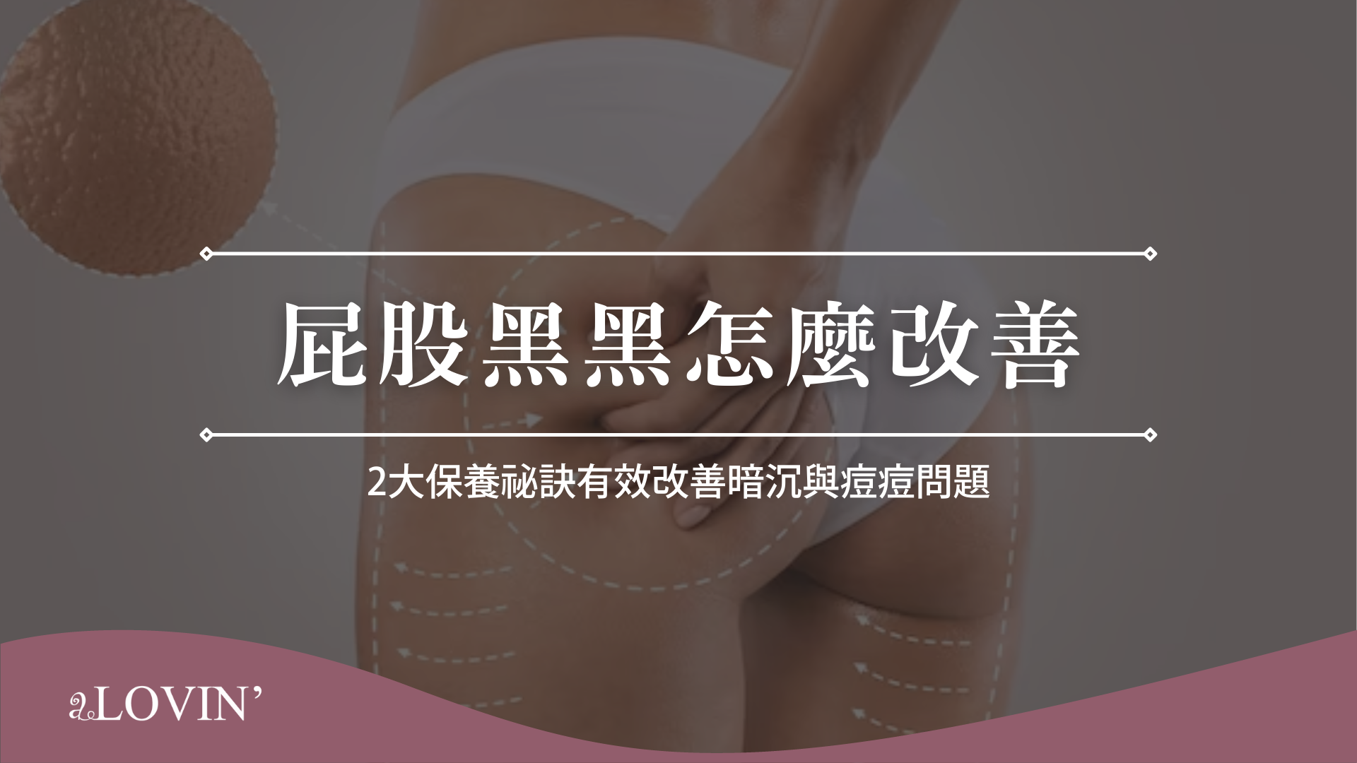 屁股黑黑怎麼改善
