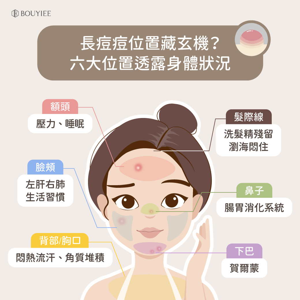 一張圖為你總結痘痘在不同位置可能透露著身體代表的狀況