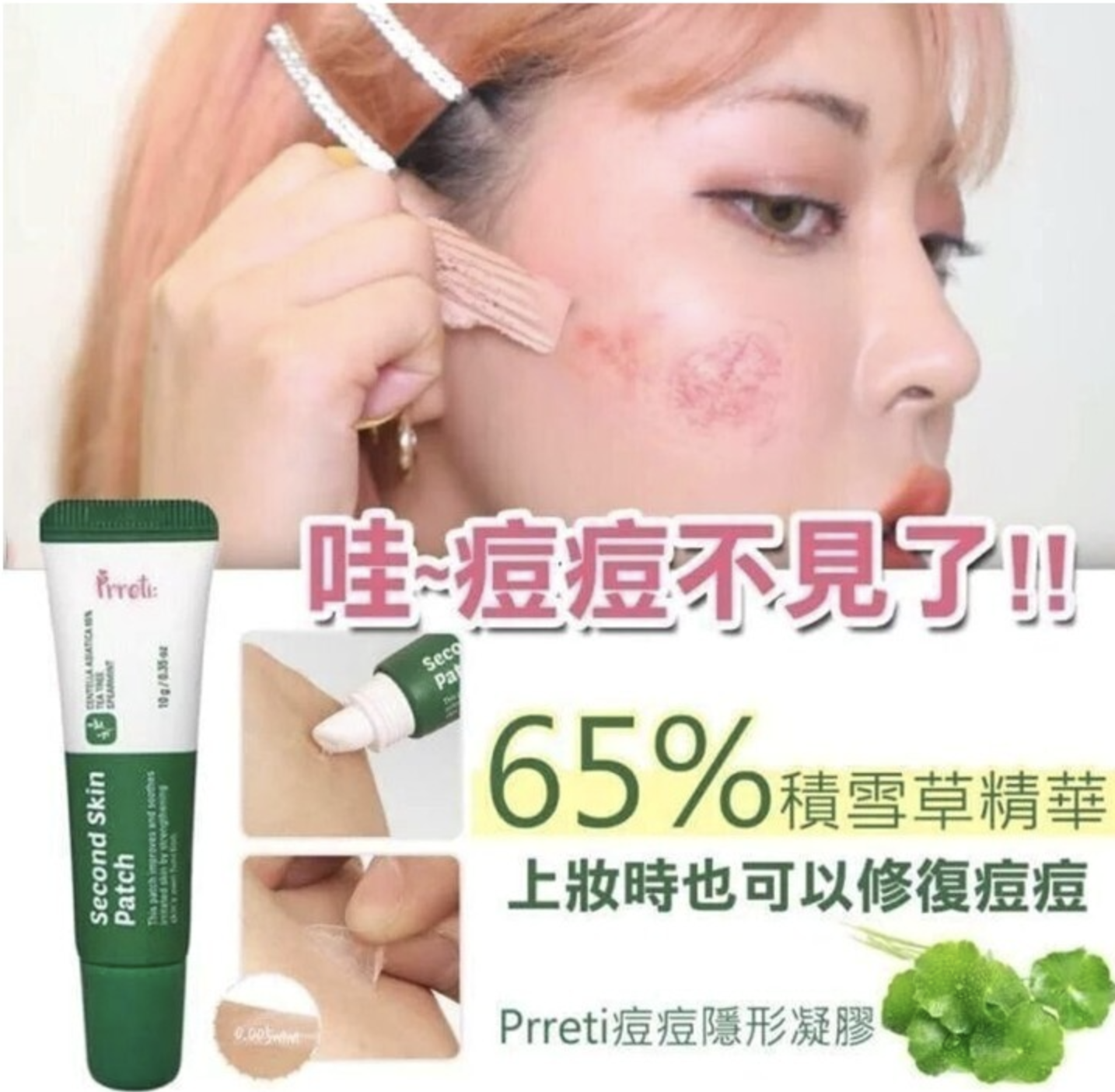 韓國🇰🇷 Prreti Second Skin Patch 隱形痘痘凝膠(10g)2件/套