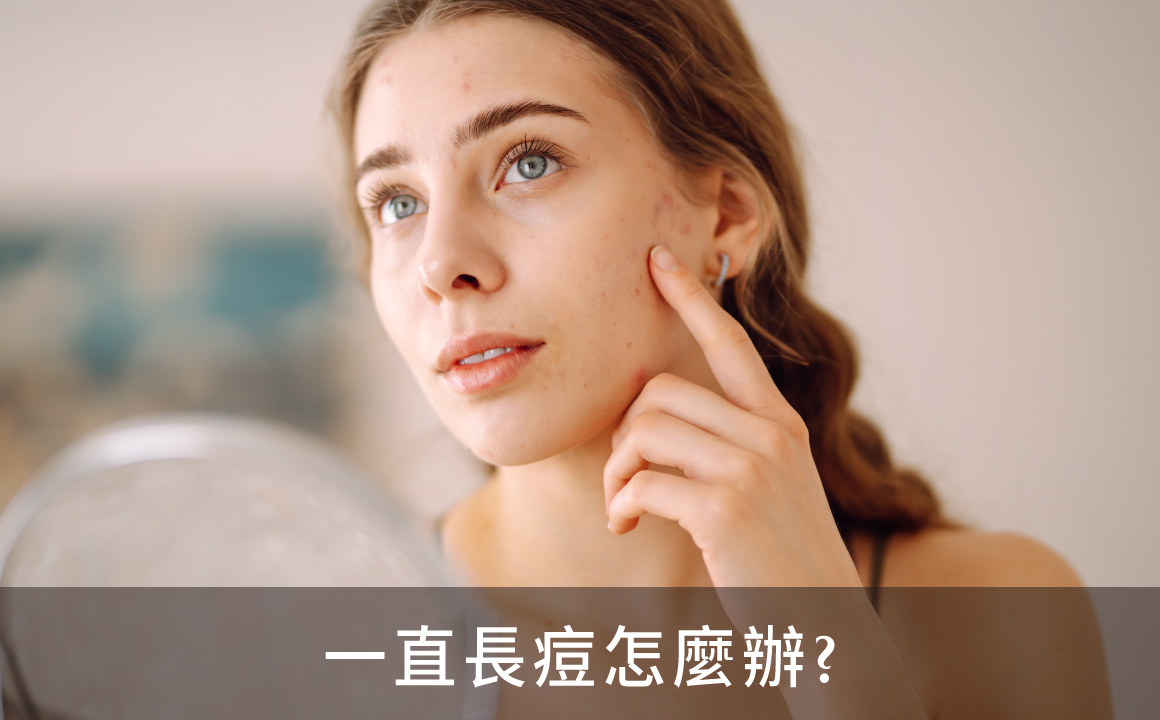 女性輕撫臉頰，臉部有輕微痘痘和泛紅，暗示痘痘和粉刺帶來的肌膚困擾。