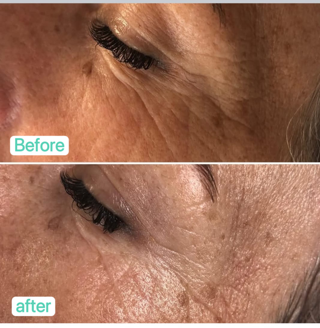 TR28 Solanie水解膠原蛋白多肽療程