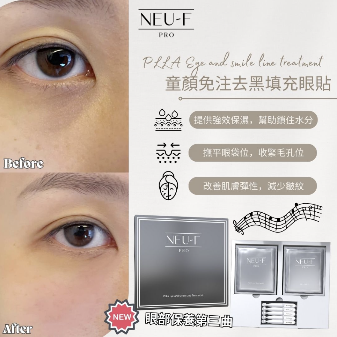 Neu-F Pro PLLA Eye and Smile Line Treatment 童顏免注去黑填充眼貼