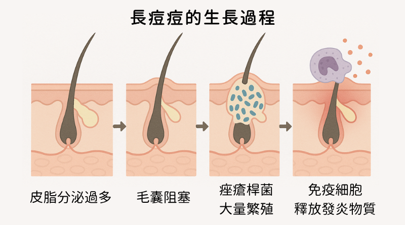 長痘痘的過程是這樣的：皮脂分泌過多 → 毛囊阻塞 → 痤瘡桿菌（Cutibacterium acnes）大量繁殖 → 免疫細胞釋放發炎物質