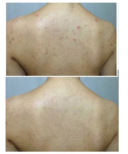 Dr.Zealous茶樹火草美背殺痘沐浴露 500ml