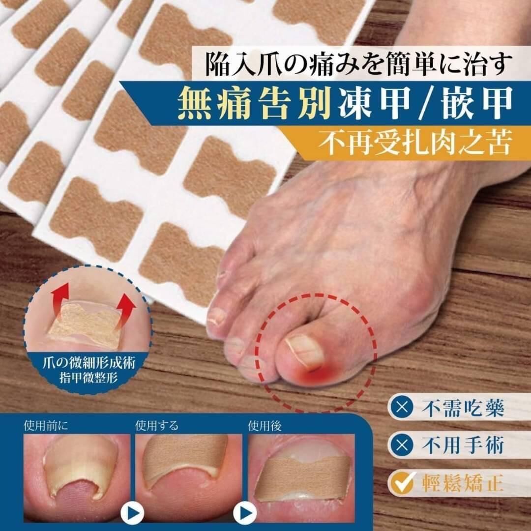 台灣無痛款嵌甲矯正貼片 (1套2盒)