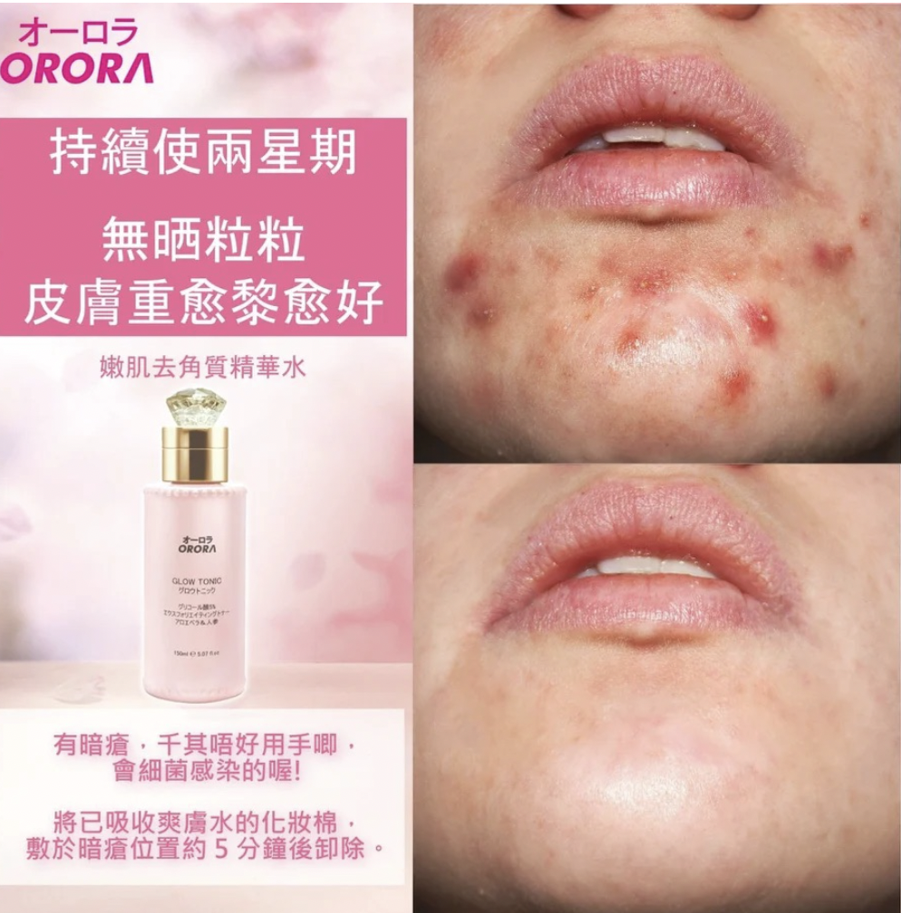 ORORA 嫩肌去角質爽膚水 150ml 化妝水  無酒精 專治療粉刺暗瘡