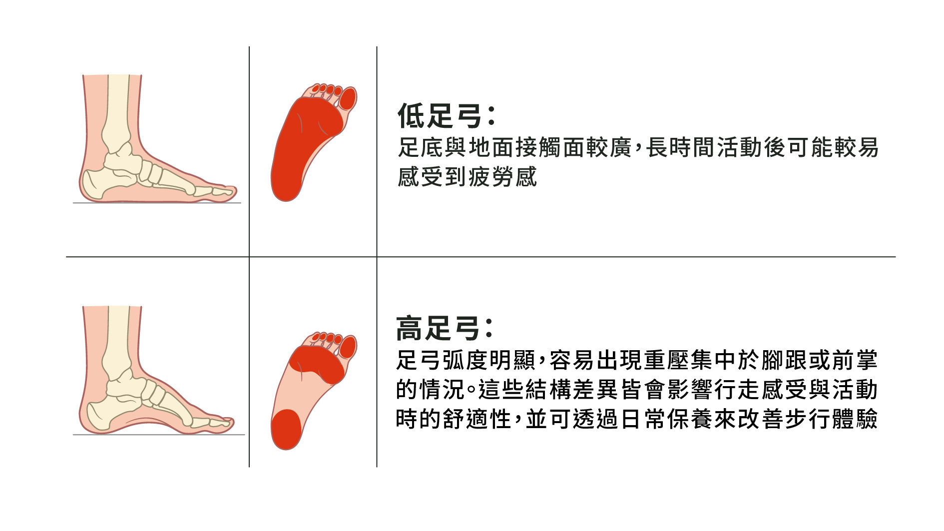 扁平足與高足弓的足印差異圖示