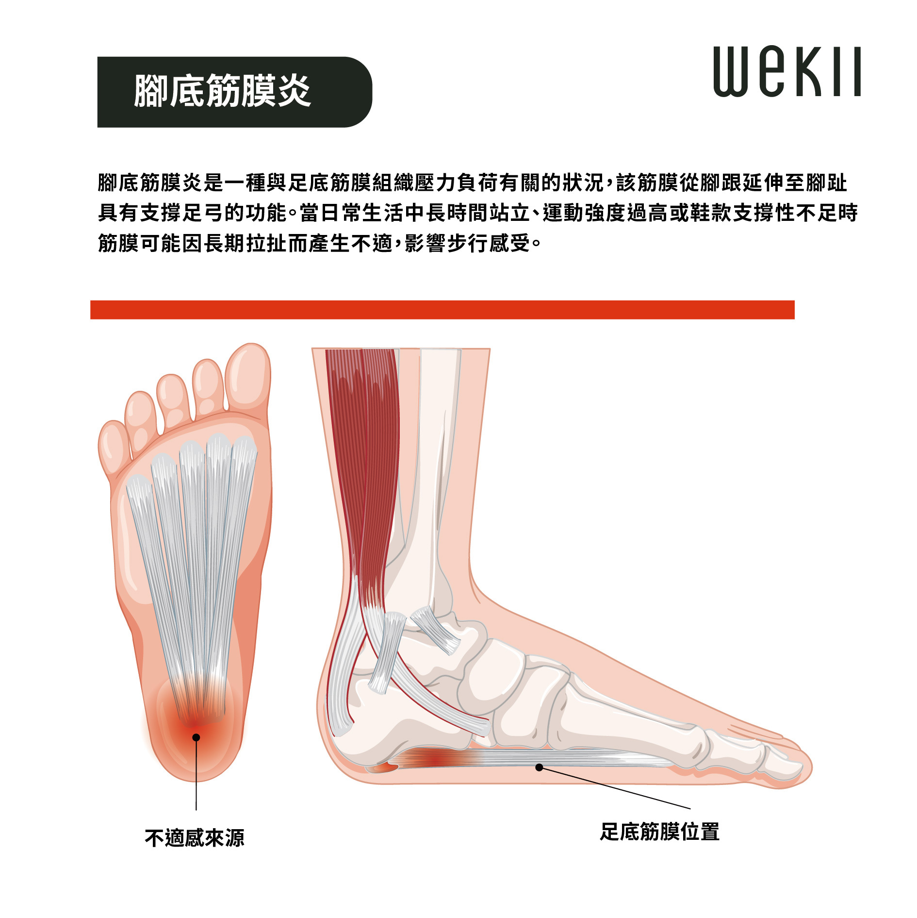 腳底筋膜炎的常見原因圖解