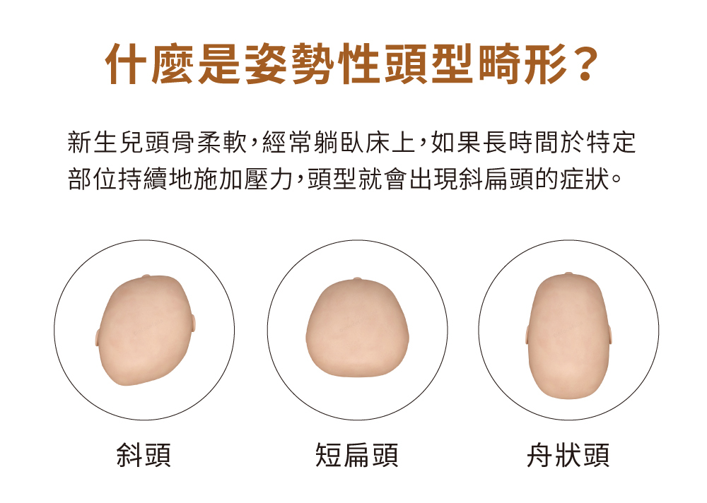 新生兒姿勢性頭型歪斜示意圖,包含斜頭、短扁頭與舟狀頭常見形狀