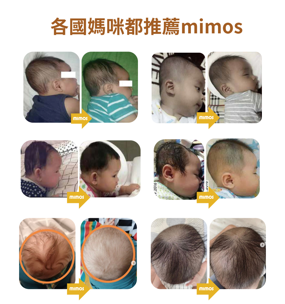 MIMOS嬰兒枕使用前後對比圖,展示寶寶頭型改善成果,獲得媽媽推薦