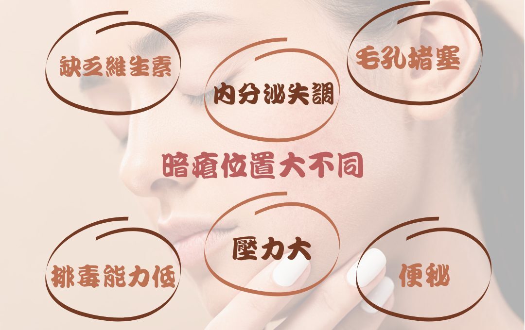 暗瘡位置原因 敏感肌暗瘡護理