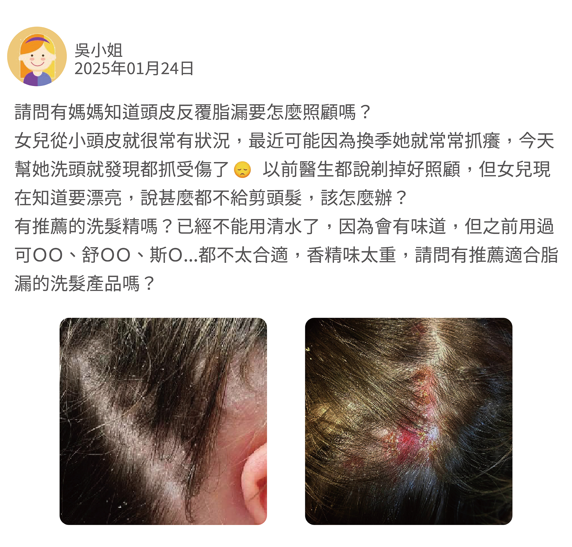 請問有媽媽知道頭皮反覆脂漏要怎麼照顧嗎？ 女兒從小頭皮就很常有狀況，最近可能因為換季她就常常抓癢，今天幫她洗頭就發現都抓受傷了        以前醫生都說剃掉好照顧，但女兒現在知道要漂亮，說甚麼都不給剪頭髮，該怎麼辦？ 有推薦的洗髮精嗎？已經不能用清水了，因為會有味道，但之前用過可ＯＯ、舒ＯＯ、斯Ｏ...都不太合適，香精味太重，請問有推薦適合脂漏的洗髮產品嗎？