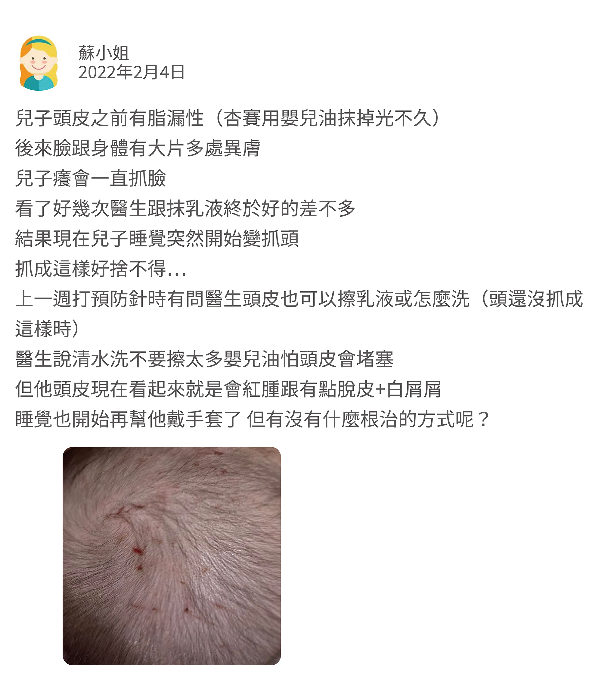 兒子頭皮之前有脂漏性（杏賽用嬰兒油抹掉光不久）後來臉跟身體有大片多處異膚，兒子癢會一直抓臉，看了好幾次醫生跟抹乳液終於好的差不多，結果現在兒子睡覺突然開始變抓頭，抓成這樣好捨不得⋯ 上一週打預防針時有問醫生頭皮也可以擦乳液或怎麼洗（頭還沒抓成這樣時） 醫生說清水洗不要多做塗抹怕頭皮會堵塞，但他頭皮現在看起來就是會紅腫+有點脫白屑屑，睡覺也開始再幫他戴手套了，但有沒有什麼根治的方式呢？