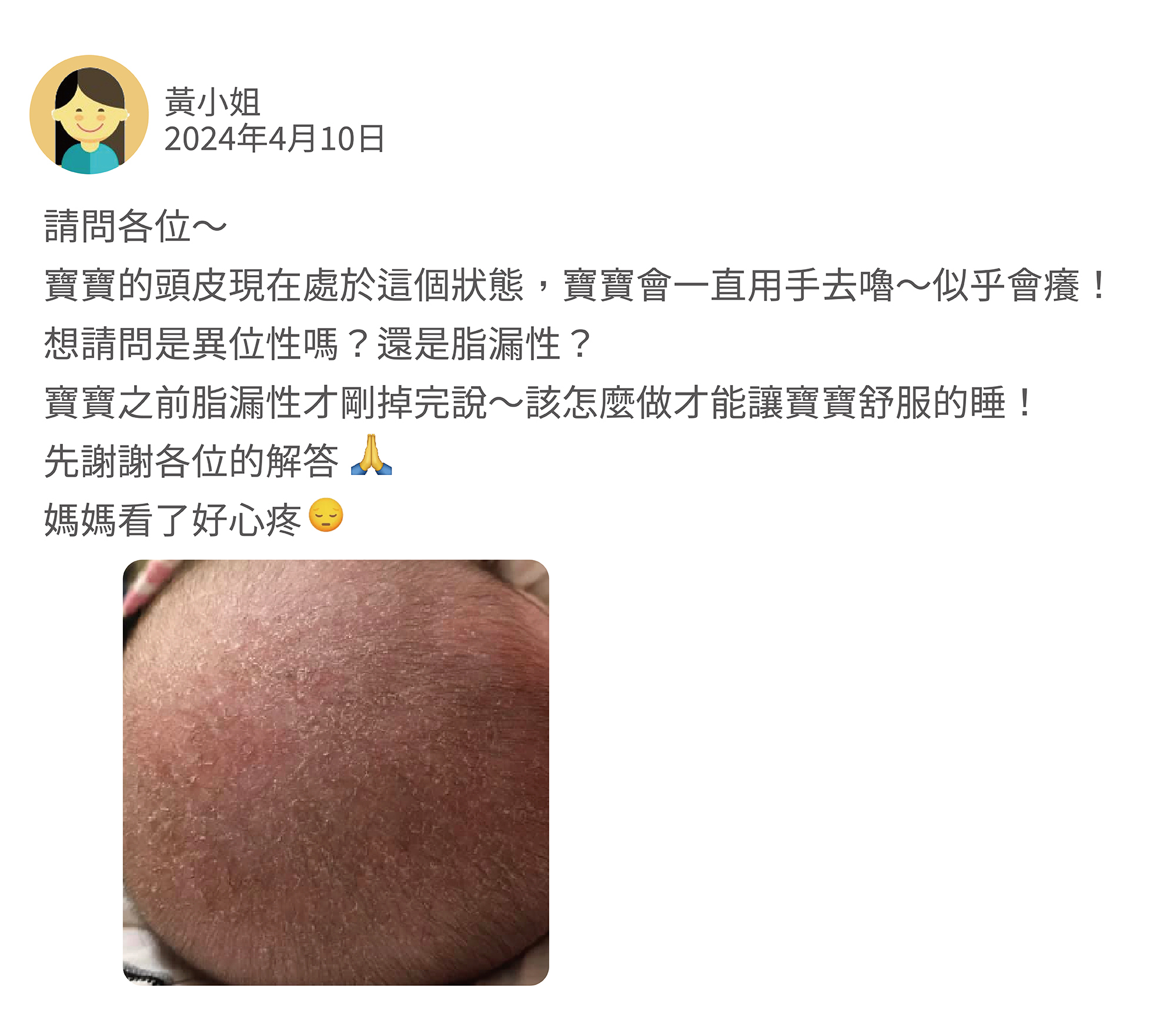 Q:請問各位～ 寶寶的頭皮現在處於這個狀態，寶寶會一直用手去嚕～似乎會癢！ 想請問是異位性嗎？還是脂漏性？ 寶寶之前脂漏性才剛掉完好轉～該怎麼做才能讓寶寶舒服的睡！ 先謝謝各位的解答，媽媽看了好心疼