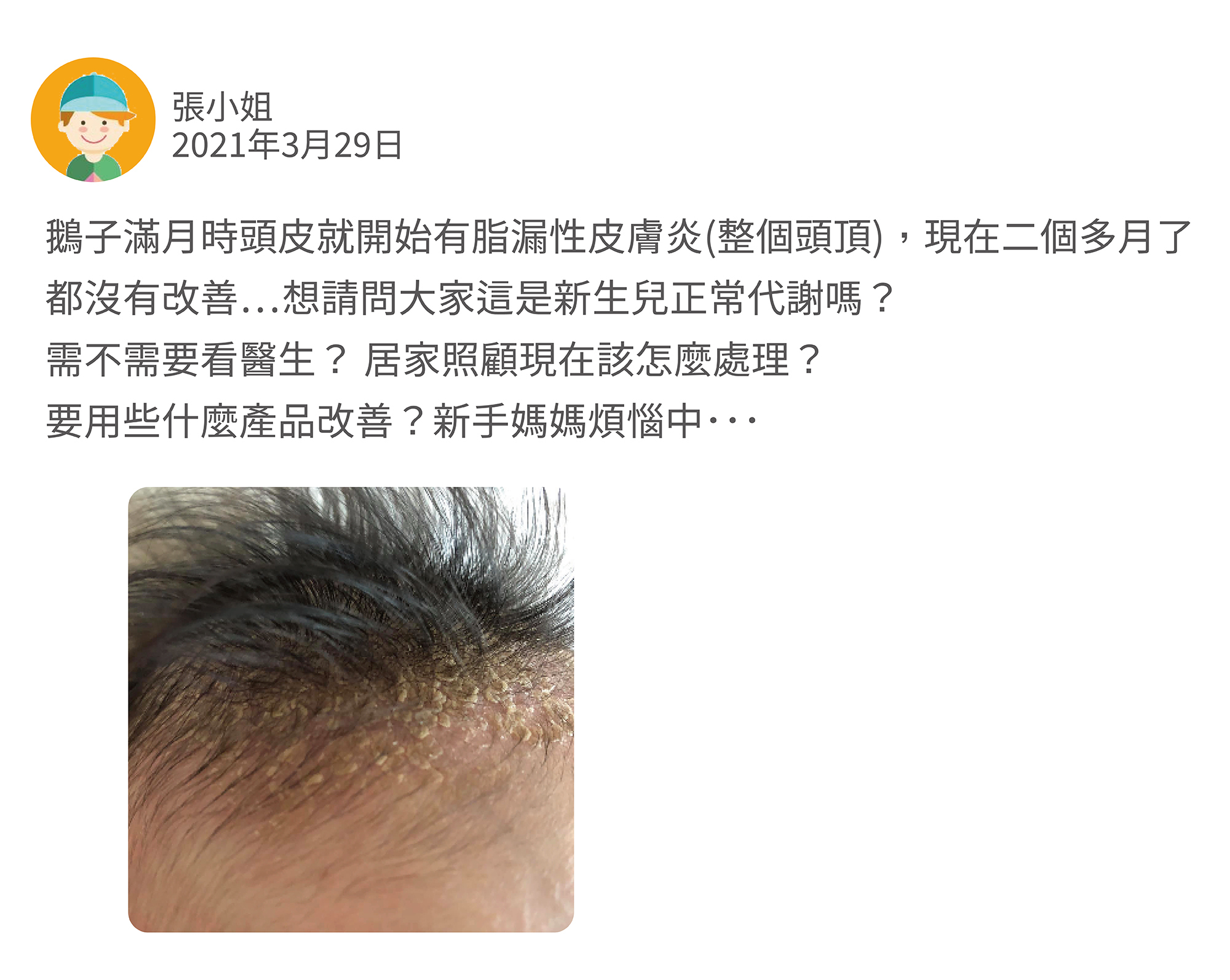 鵝子滿月時頭皮就開始有脂漏性皮膚炎(整個頭頂)，現在二個多月了都沒有改善⋯ 想請問大家這是新生兒正常代謝嗎？ 需不需要看醫生？ 居家照顧現在該怎麼處理？要用些什麼產品改善？ 新手媽媽煩惱中