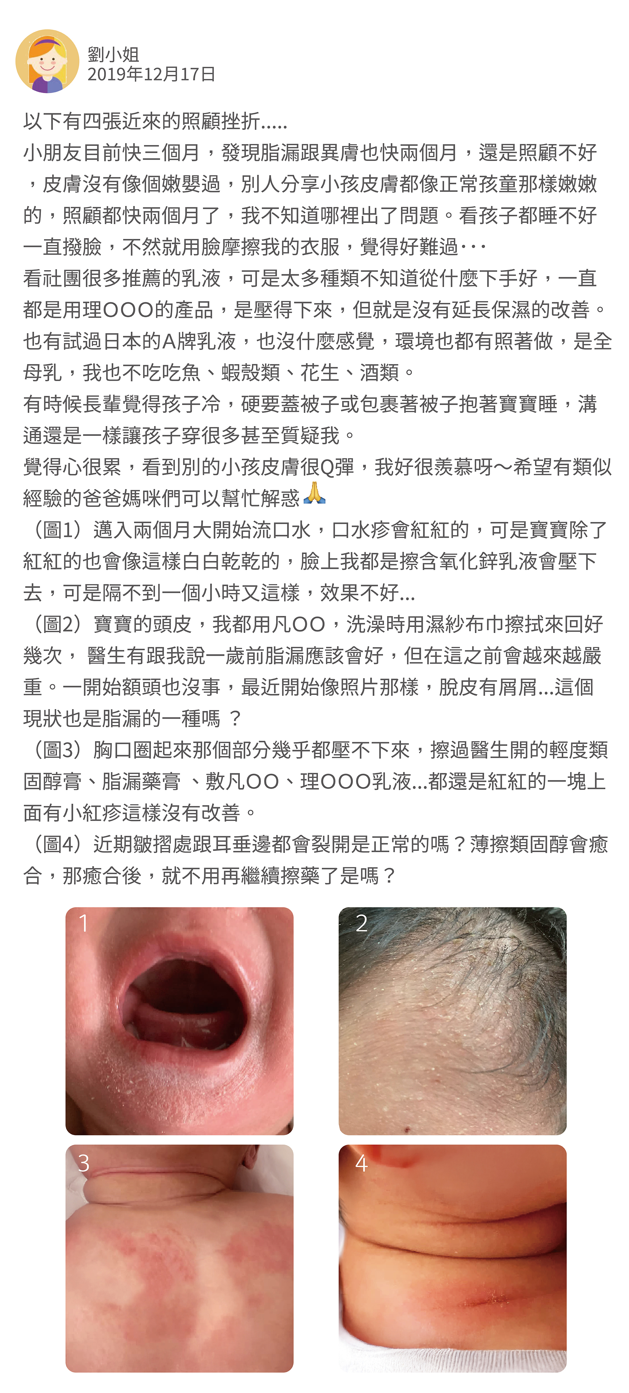 以下有四張近來的照顧挫折..... 小朋友目前快三個月，發現脂漏跟異膚也快兩個月，還是照顧不好，皮膚沒有像個嫩嬰過，別人分享小孩皮膚都像正常孩童那樣嫩嫩的，照顧都快兩個月了，我不知道哪裡出了問題。看孩子都睡不好一直撥臉，不然就用臉摩擦我的衣服，覺得好難過．．．  看社團很多推薦的乳液，可是太多種類不知道從什麼下手好，一直都是用理ＯＯＯ的產品，是壓得下來，但就是沒有延長保濕的改善。  也有試過日本的Ａ牌乳液，也沒什麼感覺，環境也都有照著做，是全母乳，我也不吃吃魚、蝦殼類、花生、酒類。 有時候長輩覺得孩子冷，硬要蓋被子或包裹著被子抱著寶寶睡，溝通還是一樣讓孩子穿很多甚至質疑我。 覺得心很累，看到別的小孩皮膚很Q彈，我好很羨慕呀～希望有類似經驗的爸爸媽咪們可以幫忙解惑 （圖1）邁入兩個月大開始流口水，口水疹會紅紅的，可是寶寶除了紅紅的也會像這樣白白乾乾的，臉上我都是擦含氧化鋅乳液會壓下去，可是隔不到一個小時又這樣，效果不好...  （圖2）寶寶的頭皮，我都用凡ＯＯ，洗澡時用濕紗布巾擦拭來回好幾次， 醫生有跟我說一歲前脂漏應該會好，但在這之前會越來越嚴重。一開始額頭也沒事，最近開始像照片那樣，脫皮有屑屑...這個現狀也是脂漏的一種嗎 ？ （圖3）胸口圈起來那個部分幾乎都壓不下來，擦過醫生開的輕度類固醇膏、脂漏藥膏 、敷凡ＯＯ、理ＯＯＯ乳液...都還是紅紅的一塊上面有小紅疹這樣沒有改善。 （圖4）近期皺摺處跟耳垂邊都會裂開是正常的嗎？薄擦類固醇會癒合，那癒合後，就不用再繼續擦藥了是嗎？