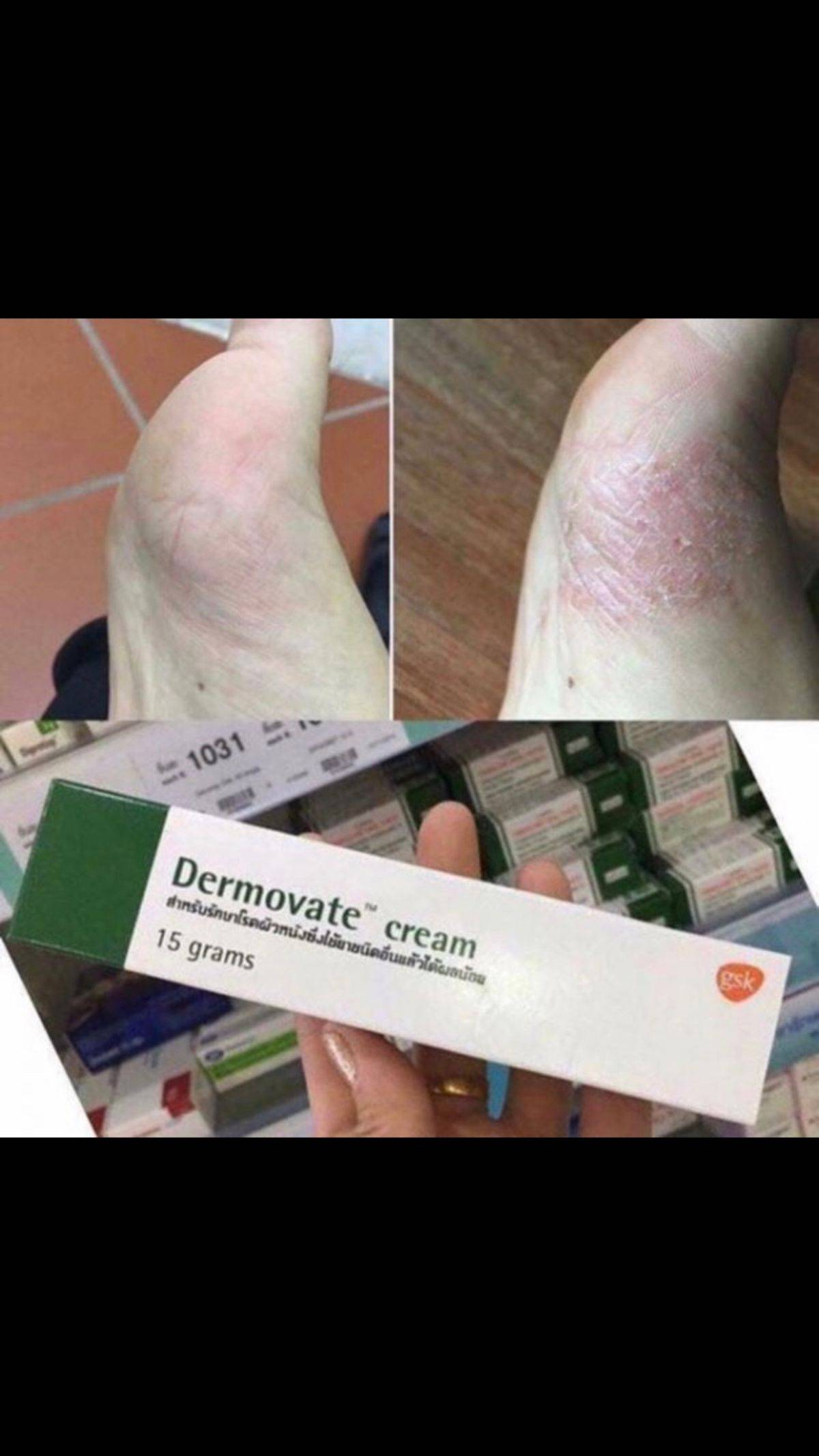 泰國 Dermovate Cream 100g｜日常肌膚乾燥不適修護乳膏