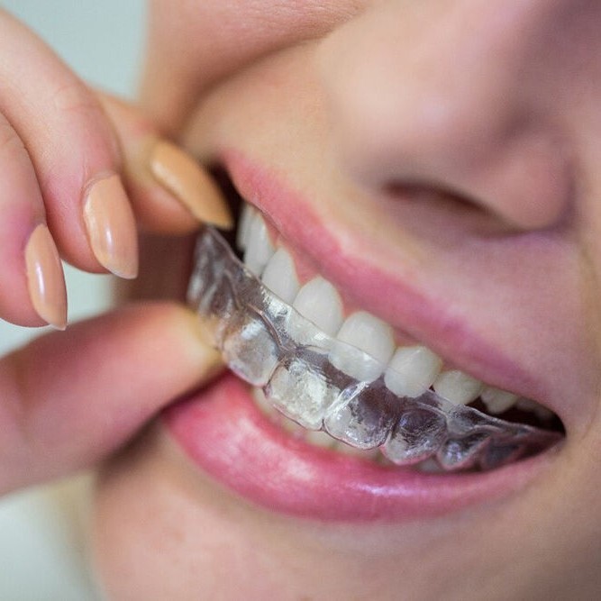 女人手握透明維持器