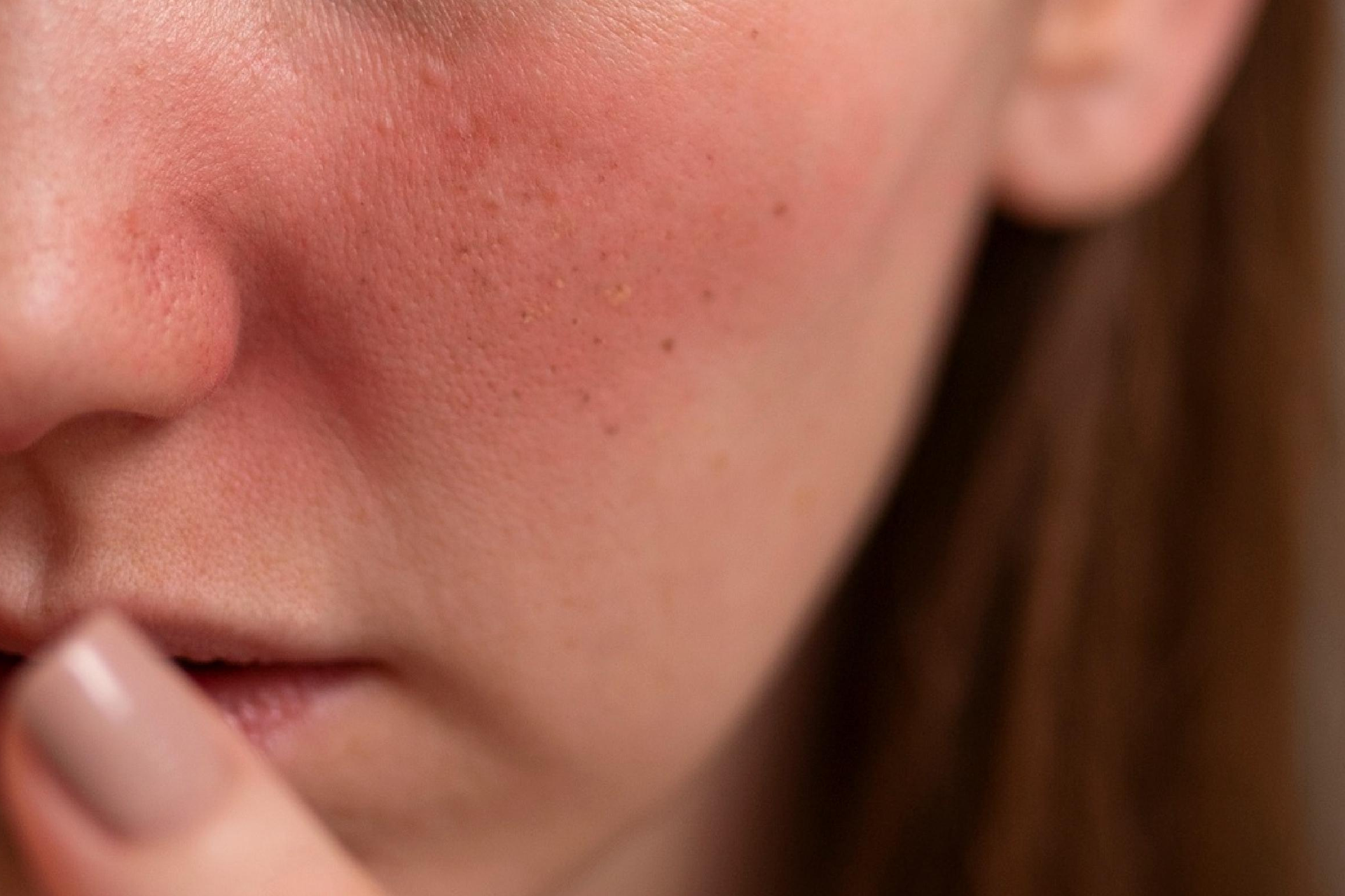 臉頰泛紅怎麼辦？是敏感肌嗎？6 個臉泛紅原因與改善對策