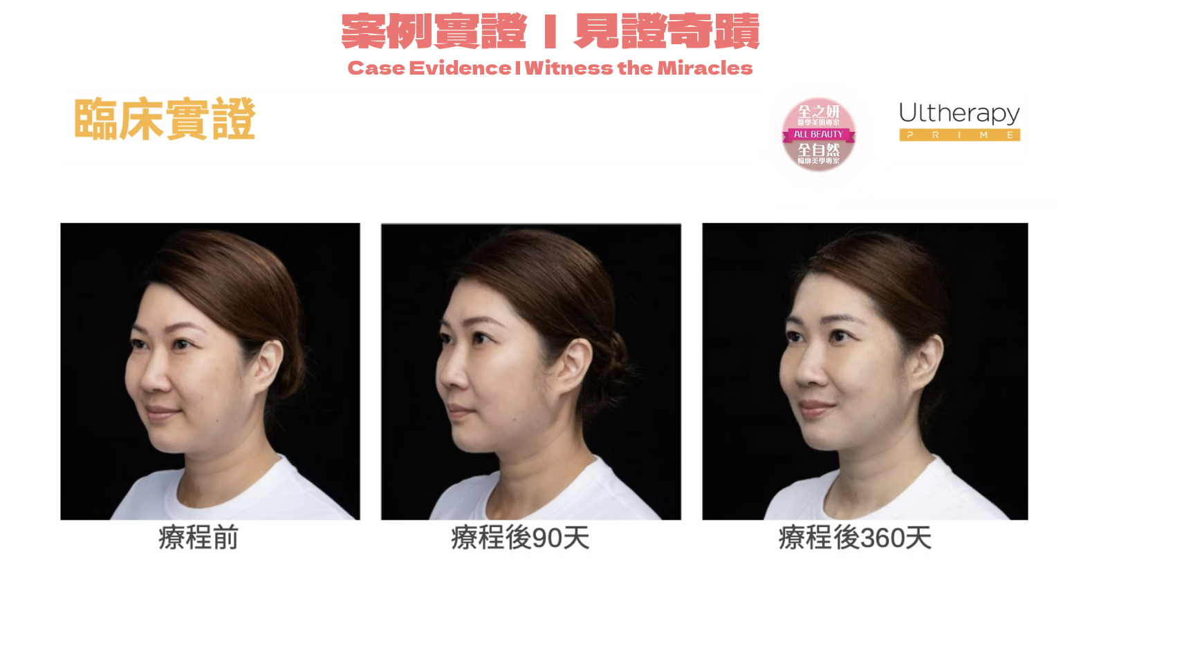 Ultherapy Prime 第二代超聲刀 美版HIFU 臨床效果