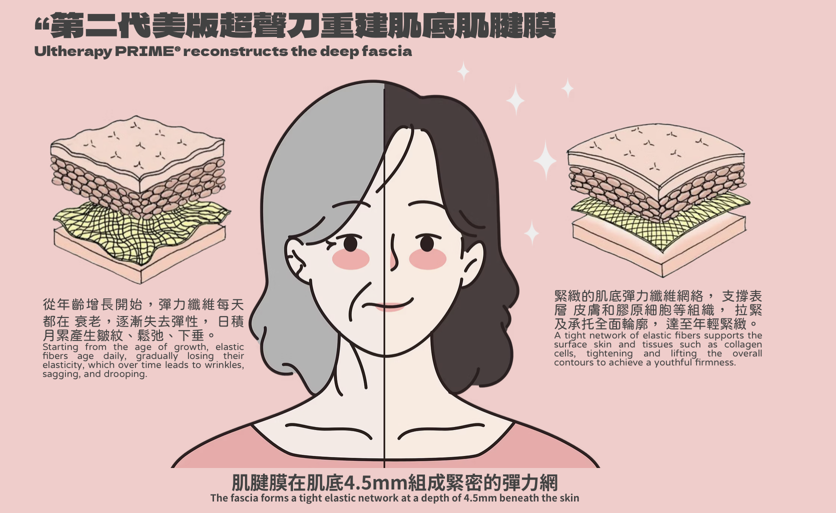 Ultherapy Prime 第二代超聲刀 美版HIFU