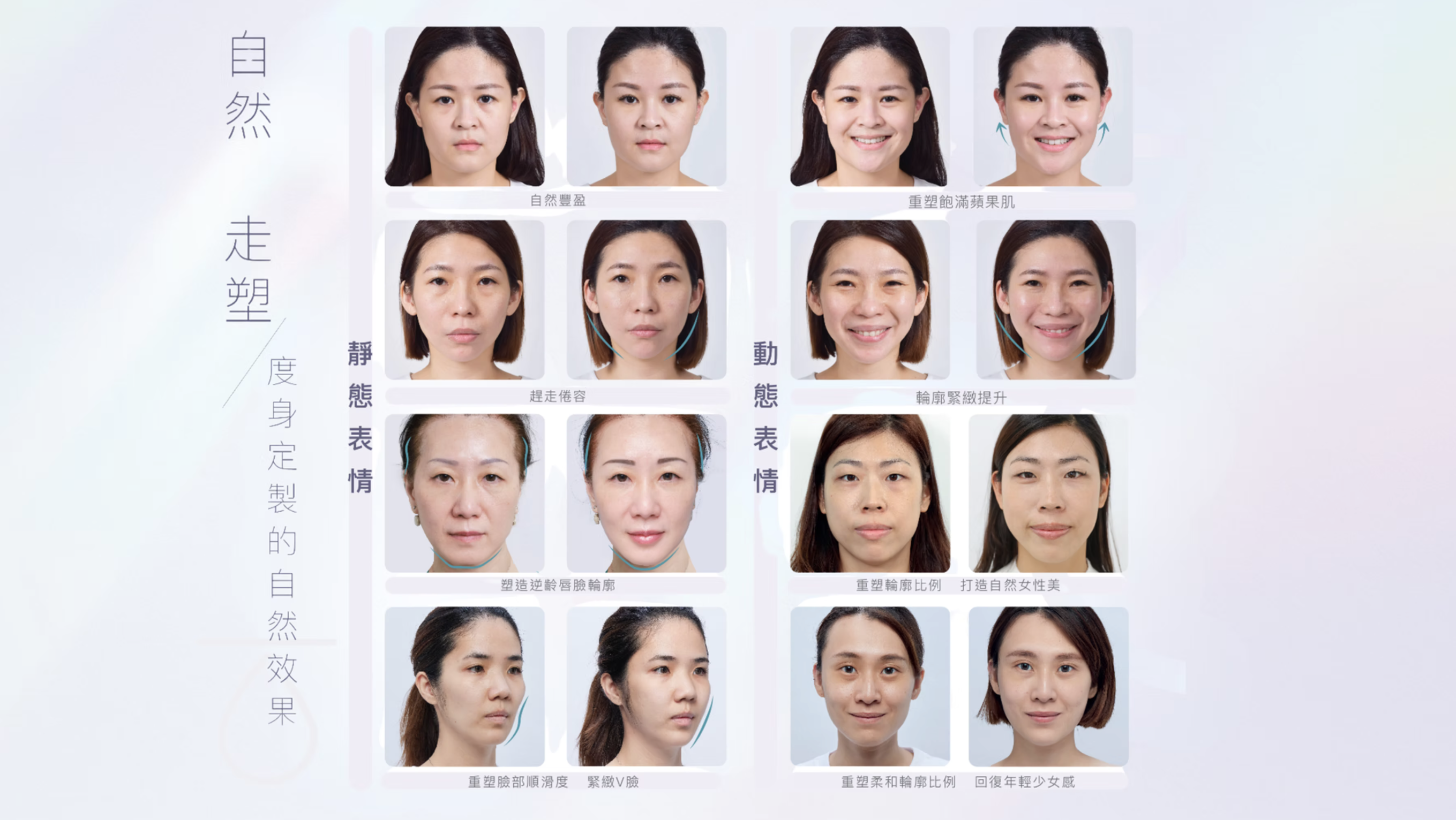 Teosyal RHA& Ultra Deep透明質酸填充系列