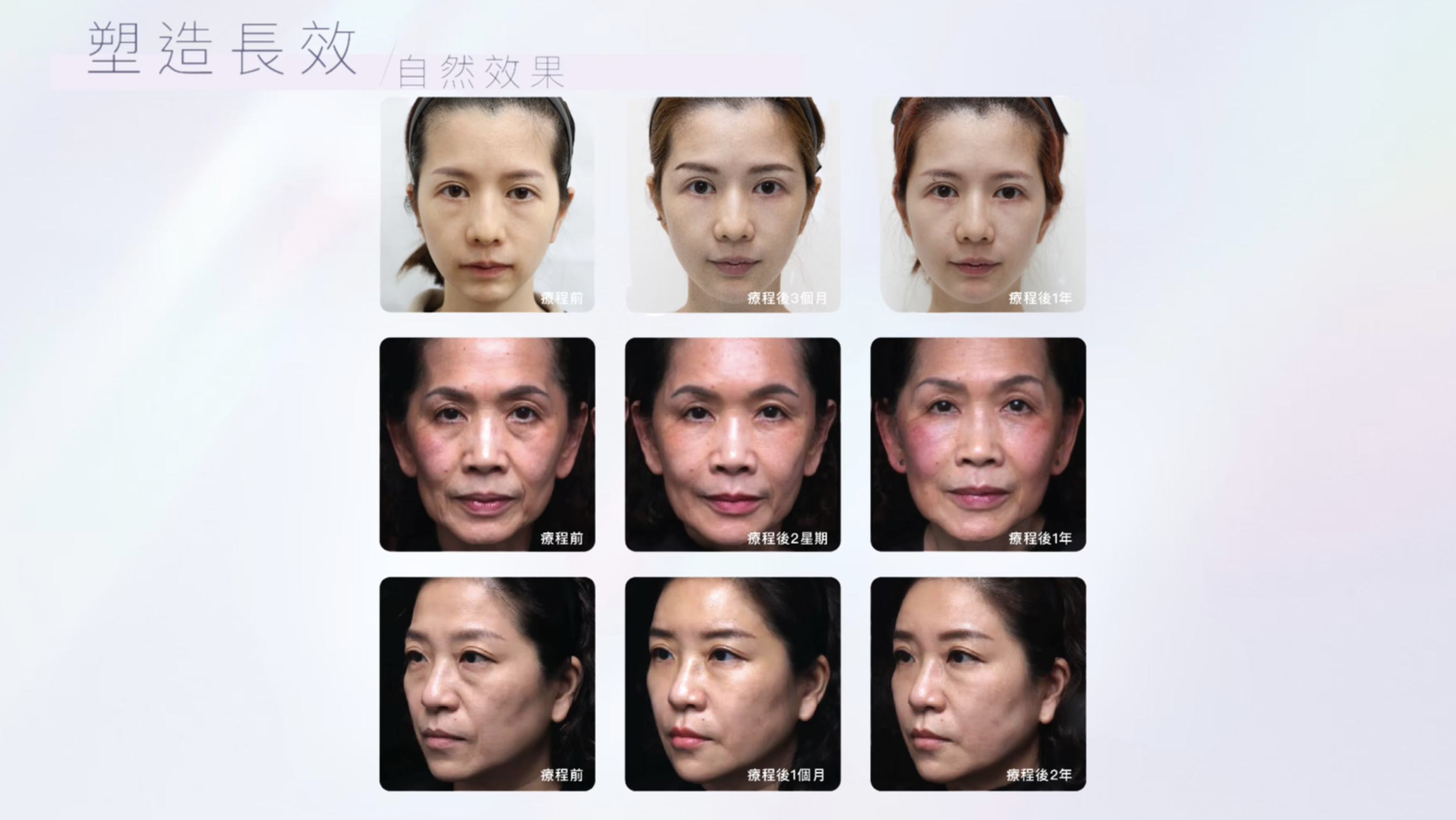 Teosyal RHA& Ultra Deep透明質酸填充系列