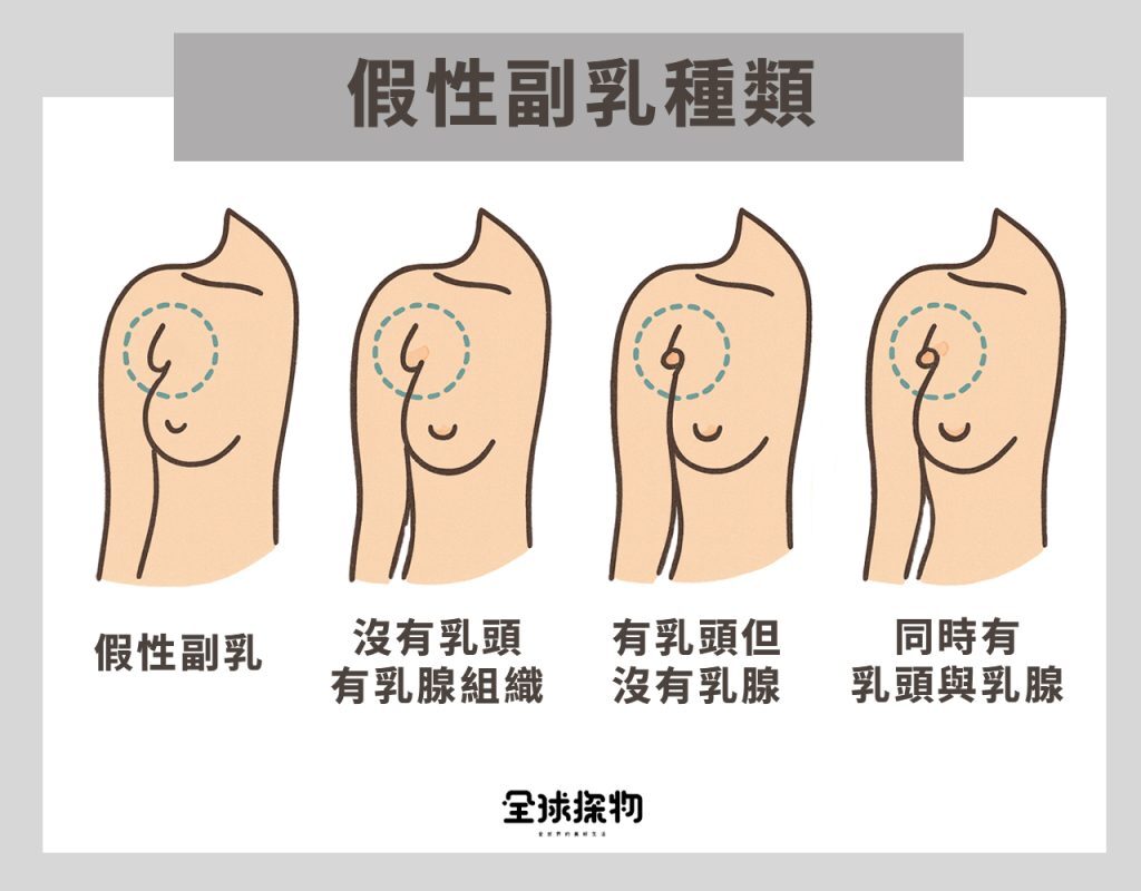 副乳怎麼消
