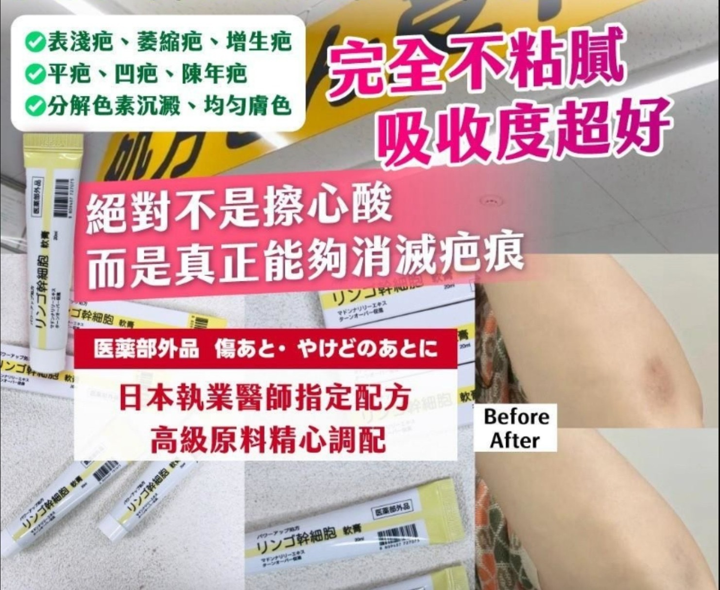 大阪心齋橋藥局限定幹細胞祛疤膏20ml