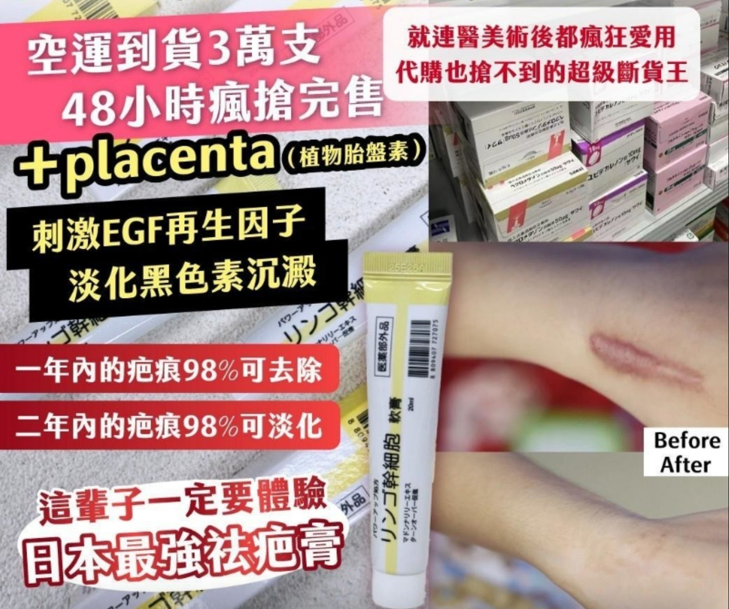 大阪心齋橋藥局限定幹細胞祛疤膏20ml