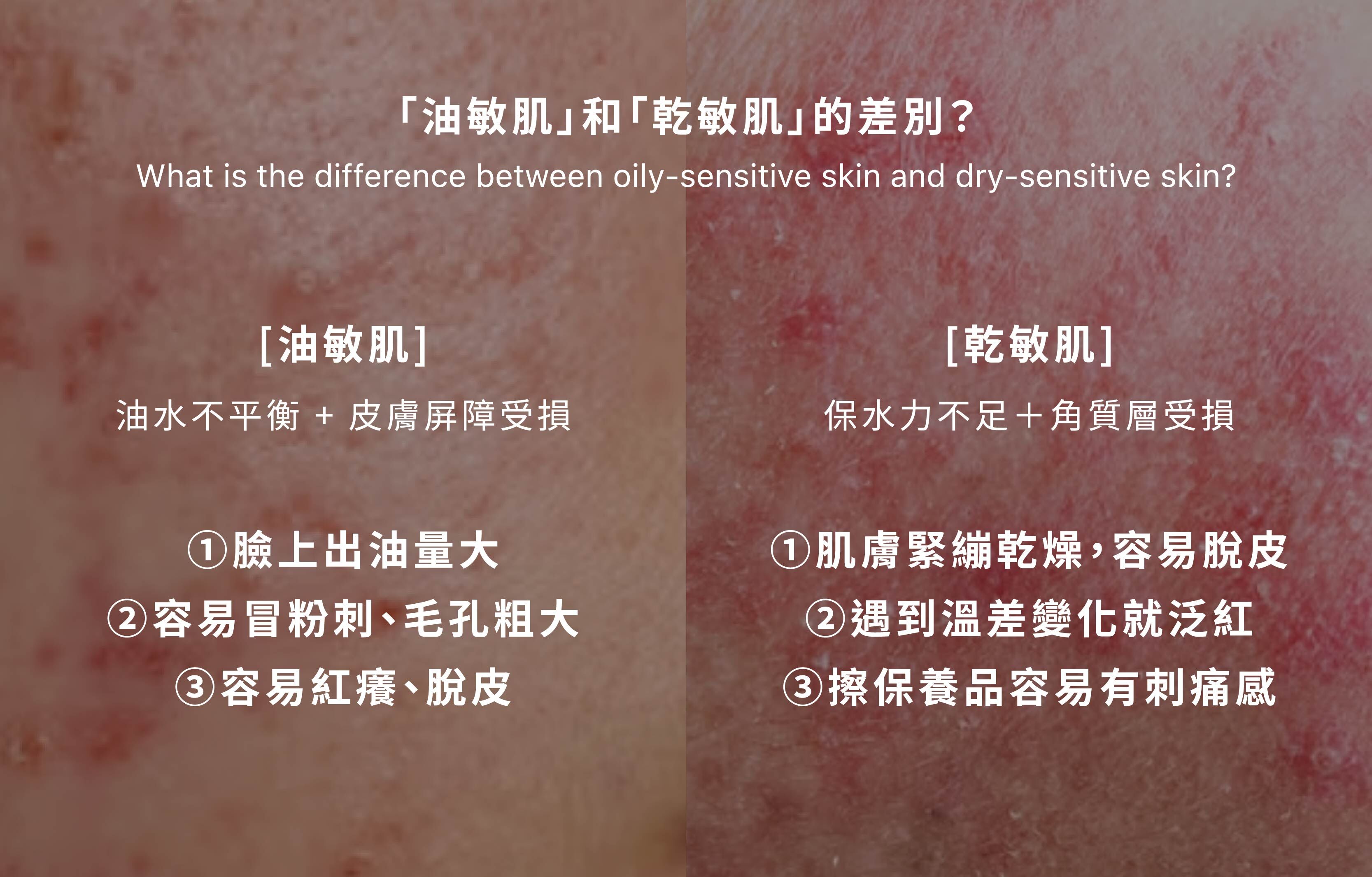 「油敏肌」和「乾敏肌」的差別？