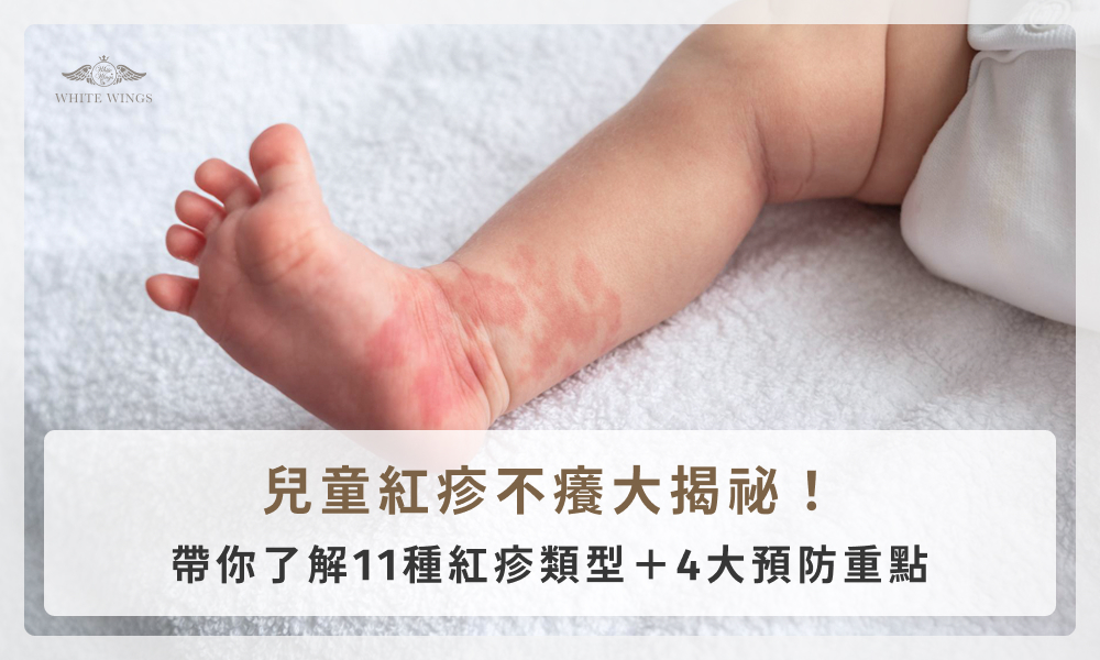 兒童紅疹不癢大揭祕！帶你了解11種紅疹類型＋4大預防重點