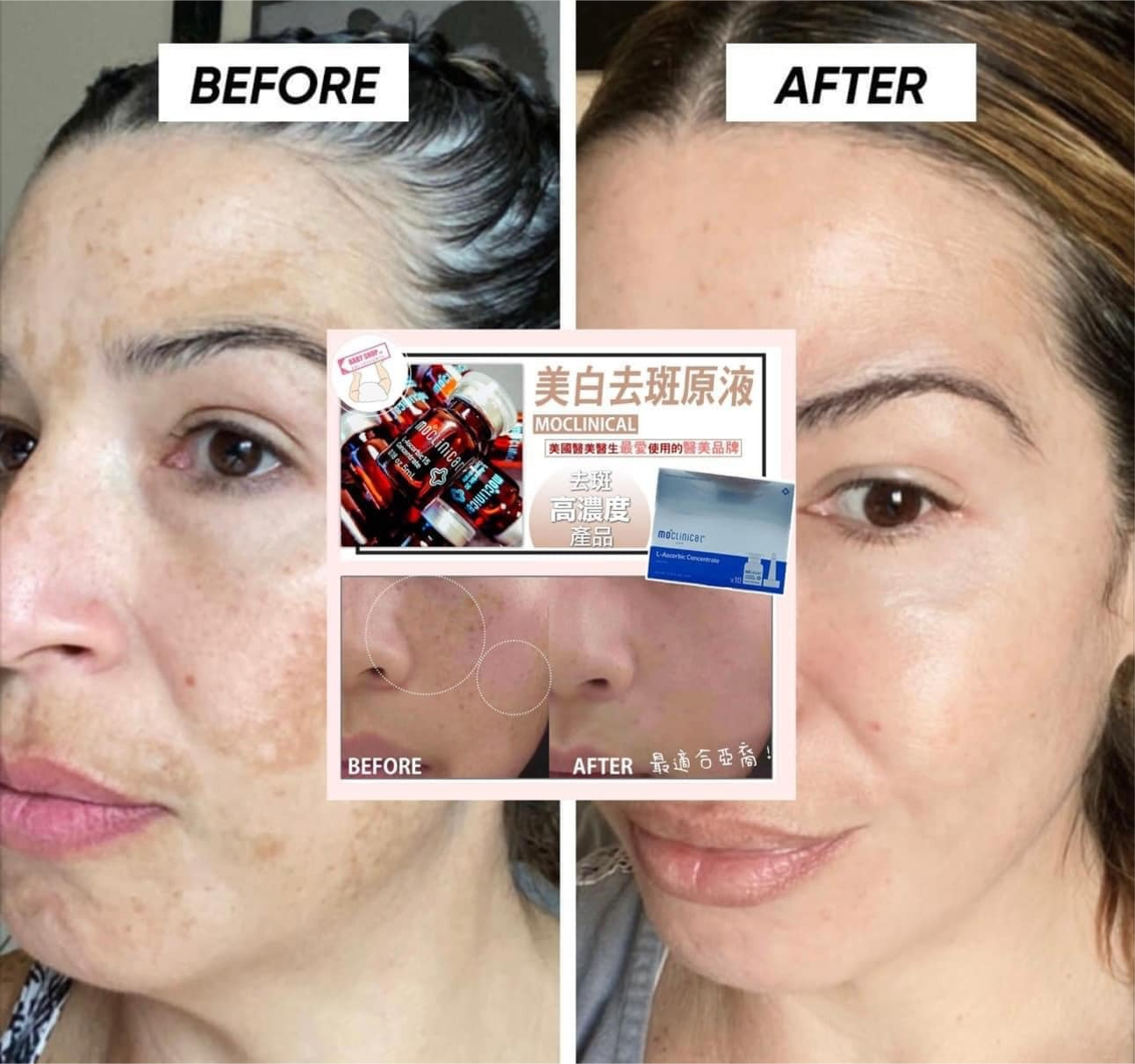 【直播】Moclinical LL091636 美白去斑原液 (10瓶裝)