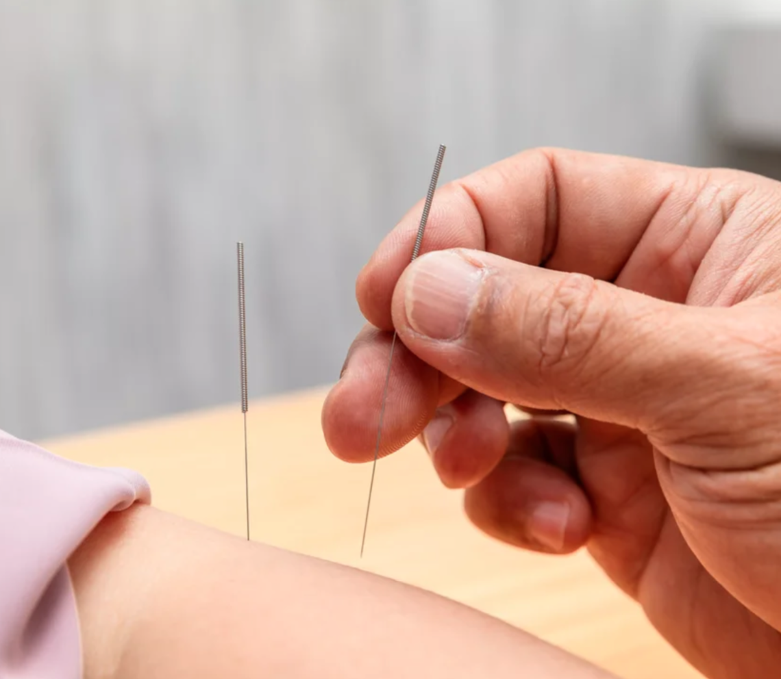 【會員方案】中醫-針灸治療 (遠端在宅)