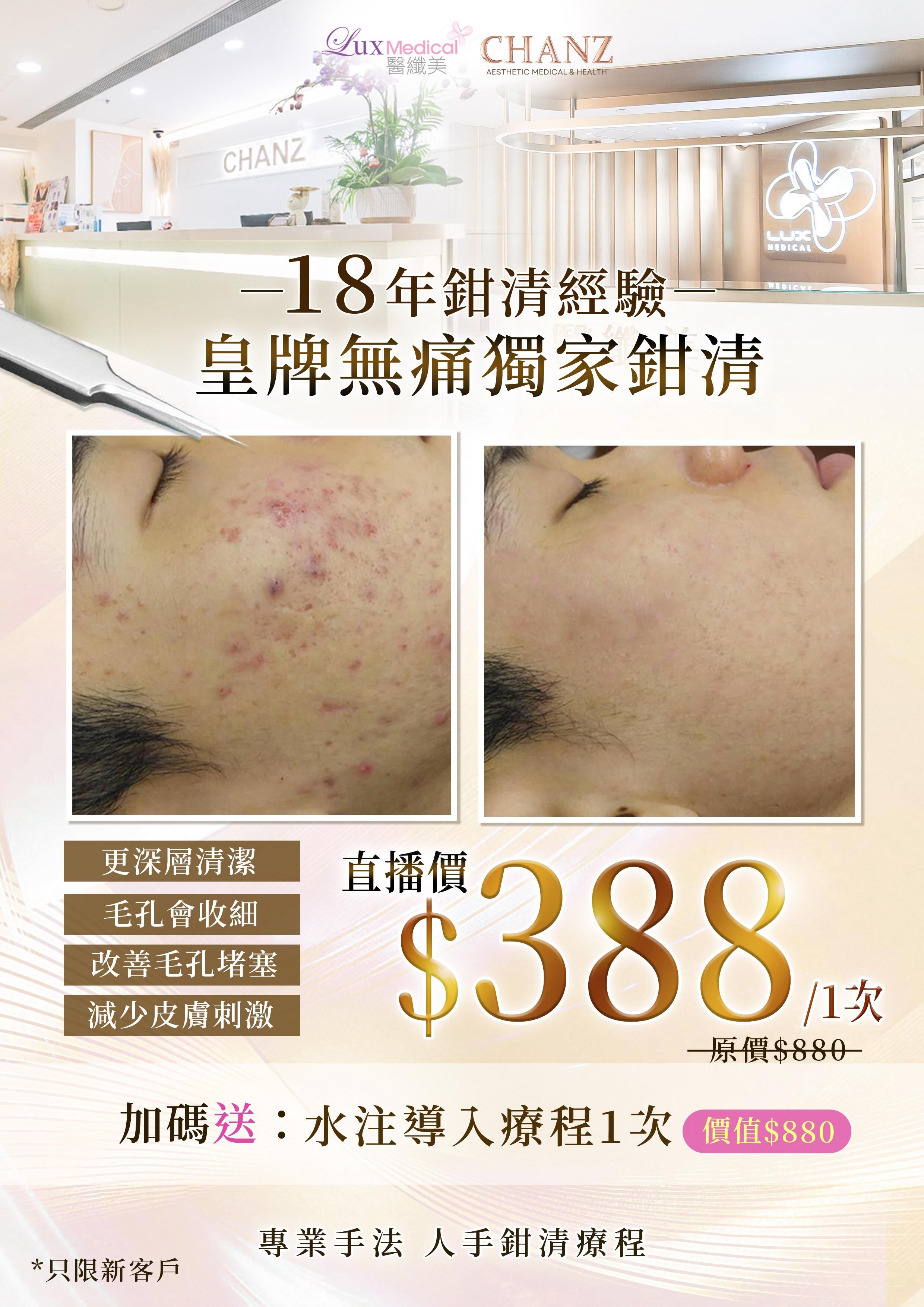 皇牌無痛獨家鉗清（原價$880） 再送水注導入（價值$880）