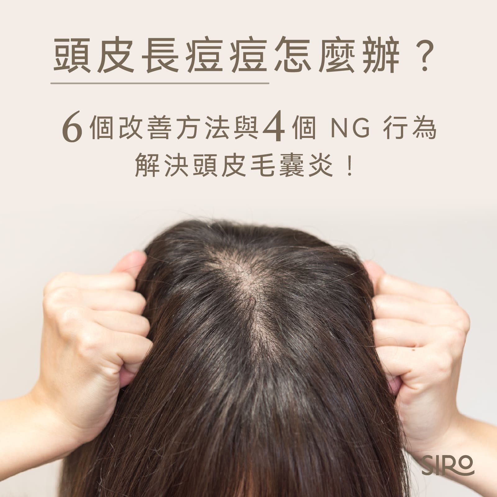 頭皮長痘痘怎麼辦？6個改善方法與4個NG行為，解決頭皮毛囊炎！