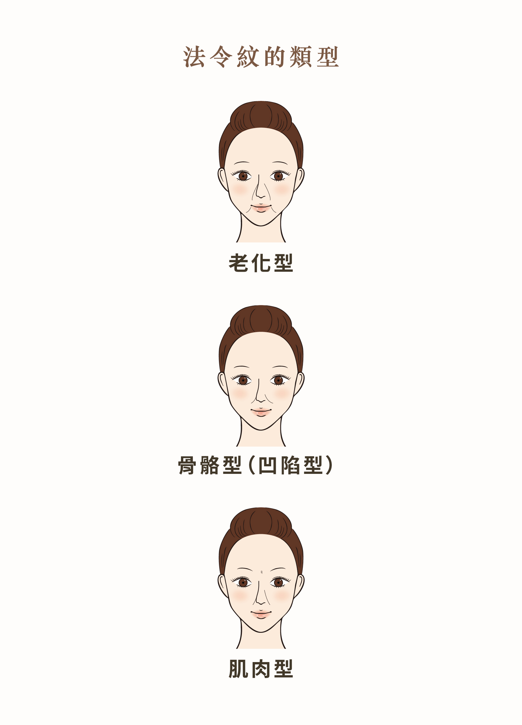 法令紋類型
