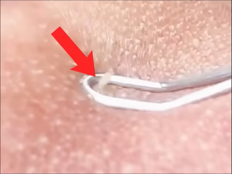 出油型毛孔的皮脂管絲