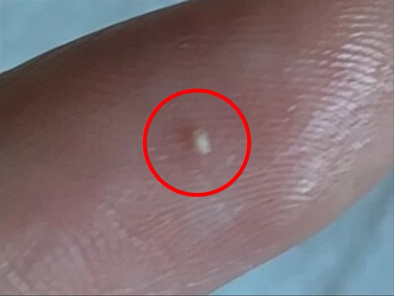 角化型毛孔擠出來的顆粒