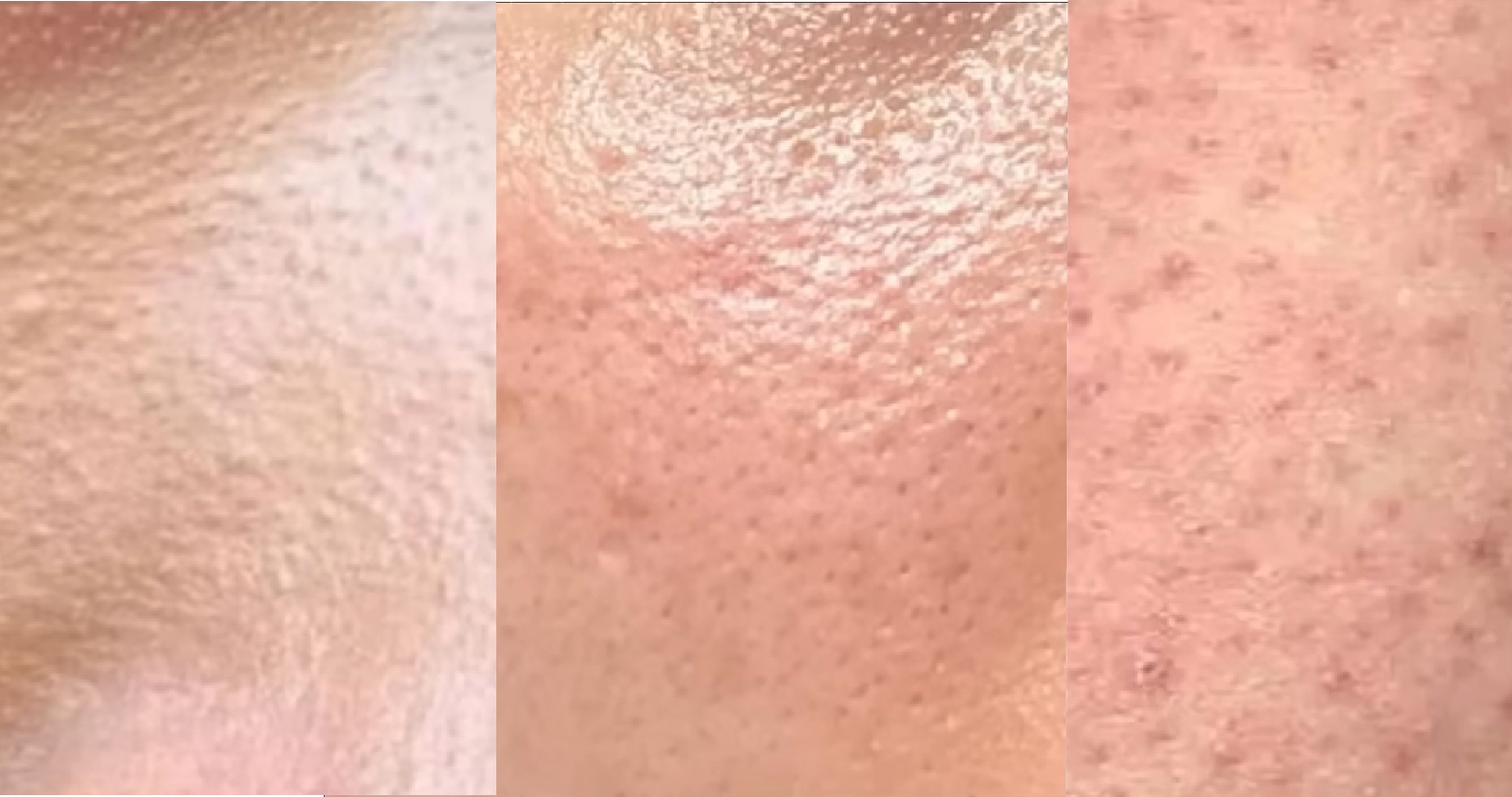 毛孔粗大? 5種問題型毛孔解決對策 & 保養品、胺基酸洗面乳推薦