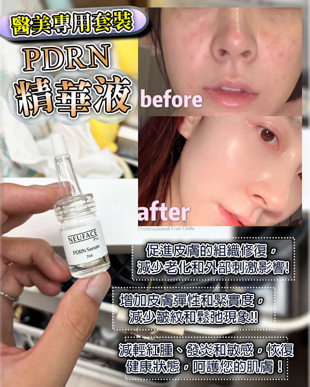 Neuface pro Professional Use Only PDRN Serum 送 Neuface Pro Gift Mask 3片