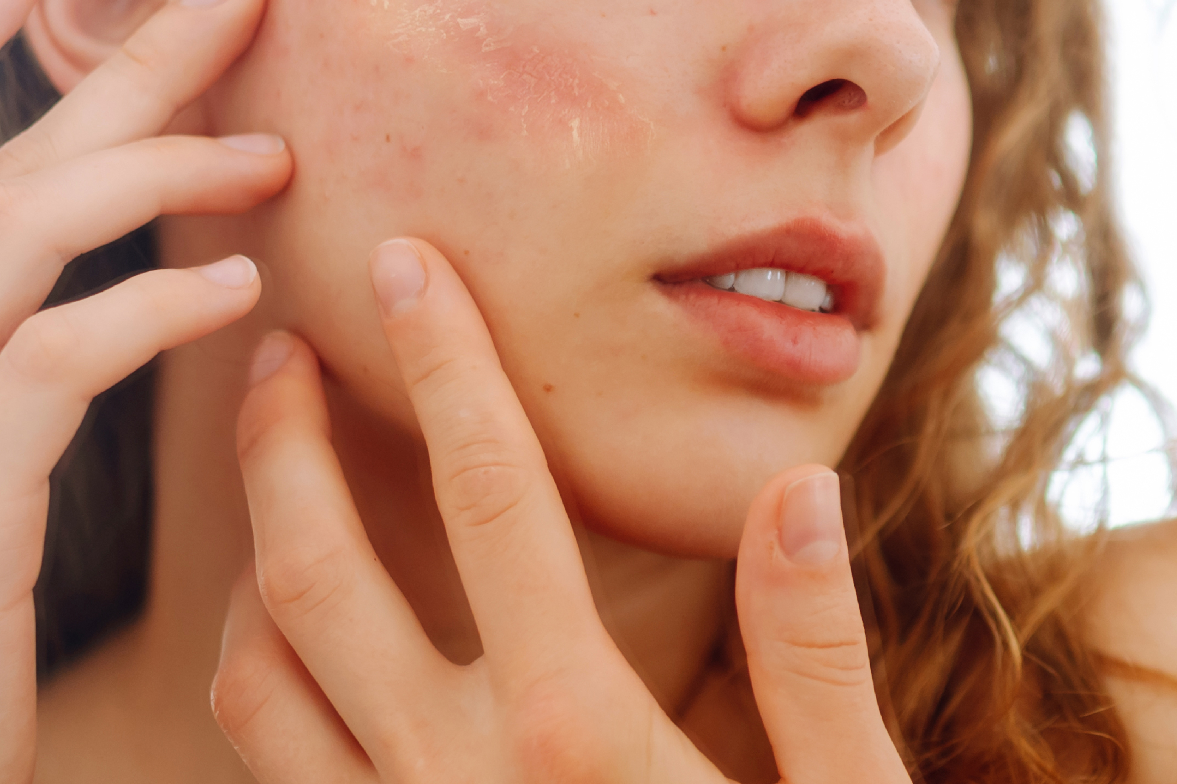 臉脫皮怎麼辦？了解臉乾燥脫皮 6 原因與日常修護的保養步調