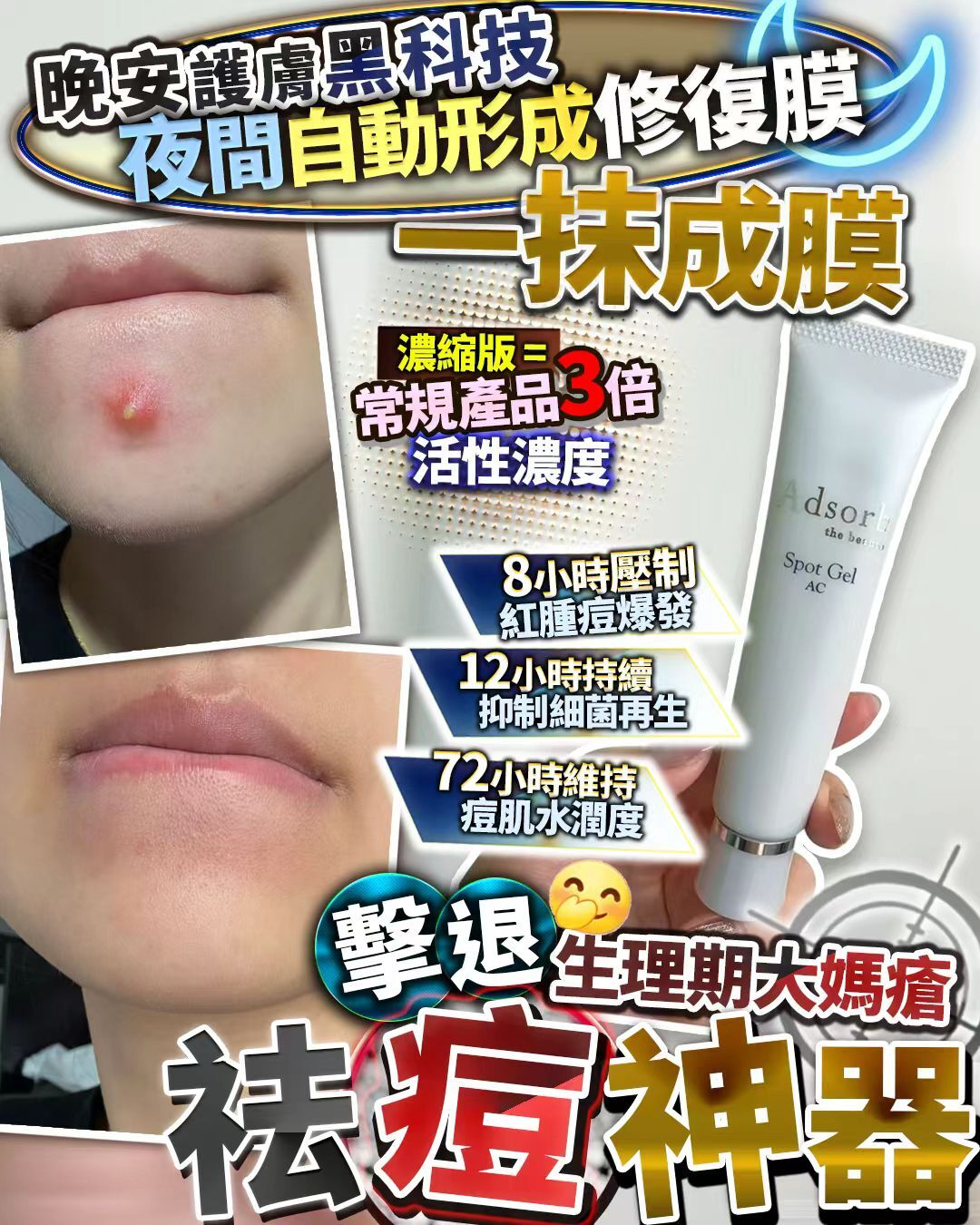 暗瘡終結者 25g Z640（2-3星期寄出）