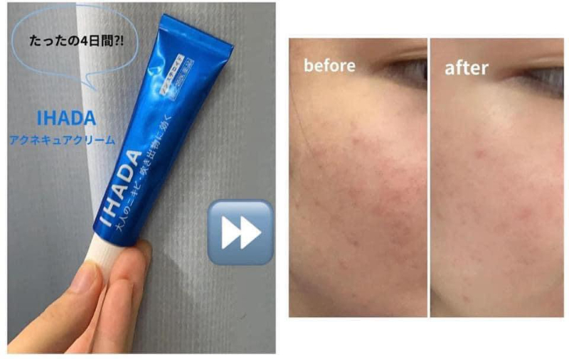 資生堂｜IHADA痘痘治療軟膏 16g