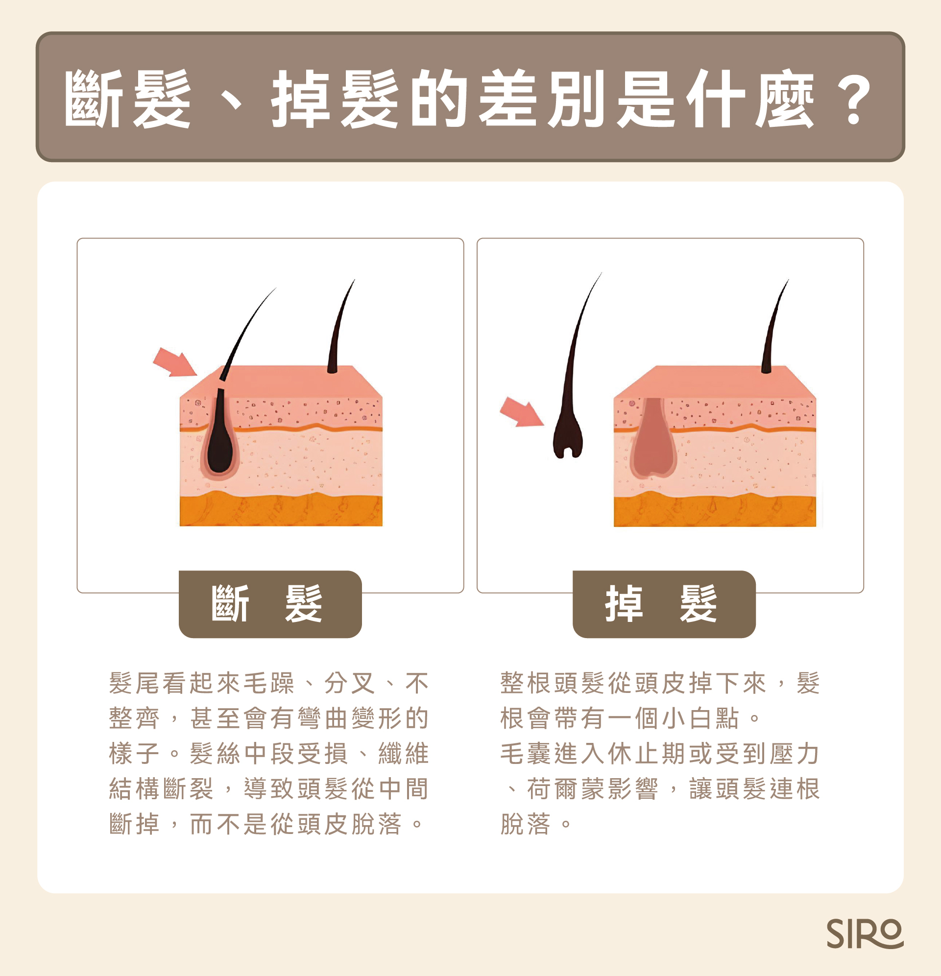 斷髮掉髮的差別是什麼?斷髮是髮絲中段受損、纖維結構斷裂,導致頭髮從中間斷掉;掉髮是指整根頭髮從頭皮掉下來,髮根會有一個小白點