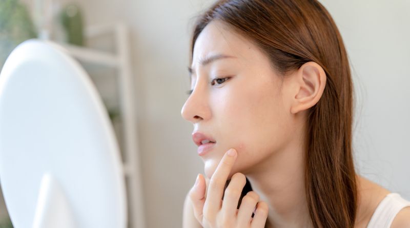 下巴壓力型痘痘集中在下顎線