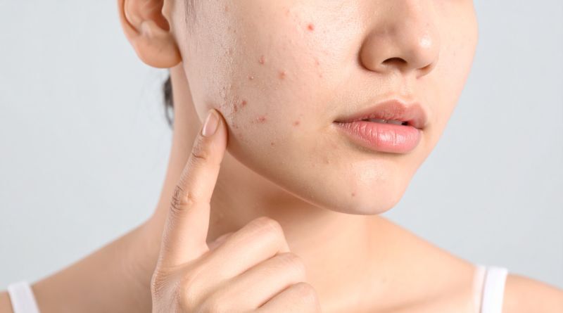 壓力大,所以臉部下巴長滿痘痘